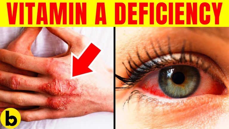 9 Sneaky Symptoms That Can Be A Sign of a Vitamin A Deficiency