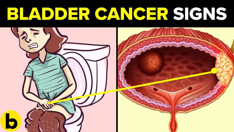 5 Early Signs of Bladder Cancer Mostly Ignored By People