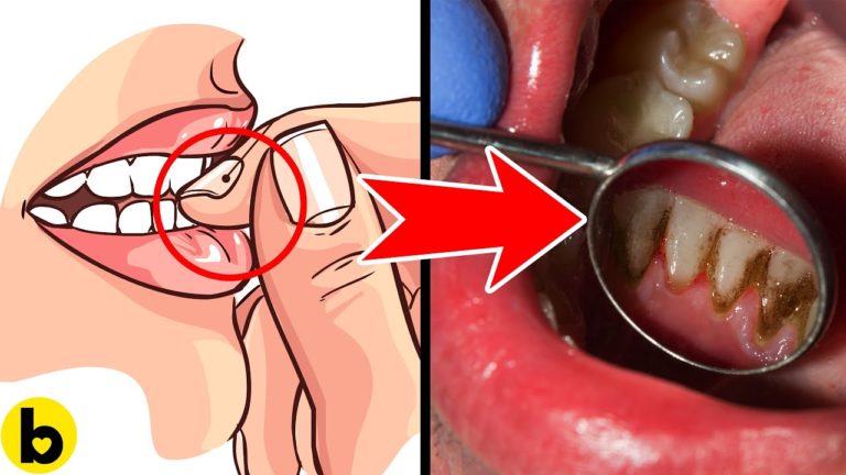 16 Sneaky Reasons Why You Get Cavities