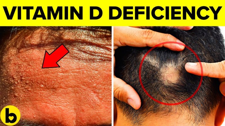 8 Signs Your Body Is Desperate For Vitamin D