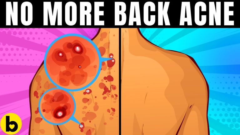 14 Ways To Get Rid Of Back Acne Once And For All